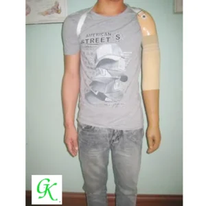 Tay giả trên khủy